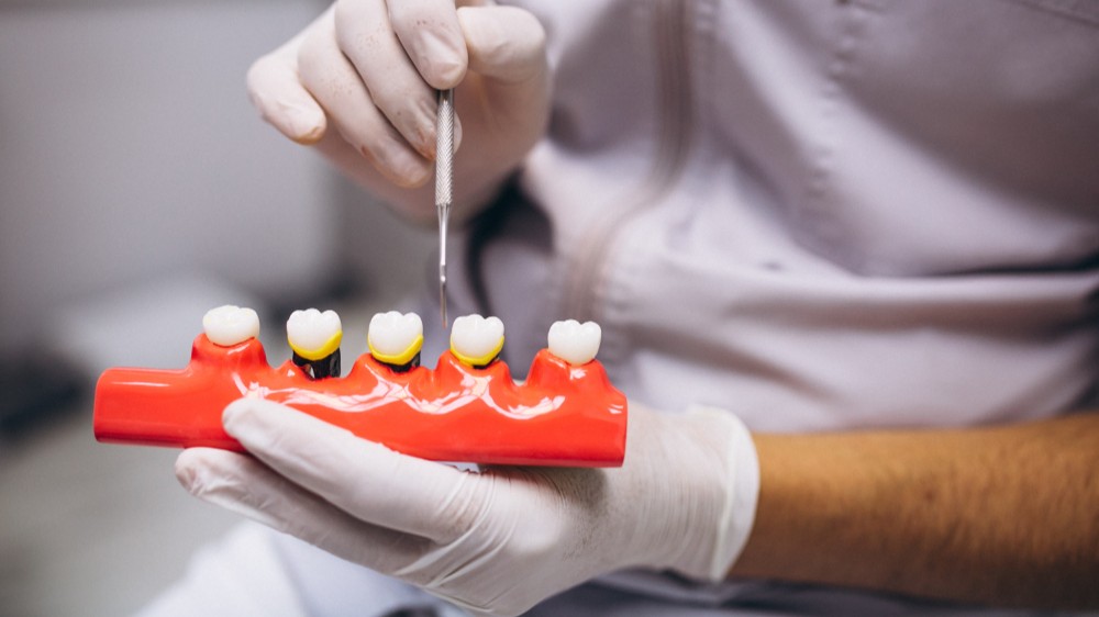 Full Mouth Dental Implants | Permanent and Aesthetic Solution - PYS Dent